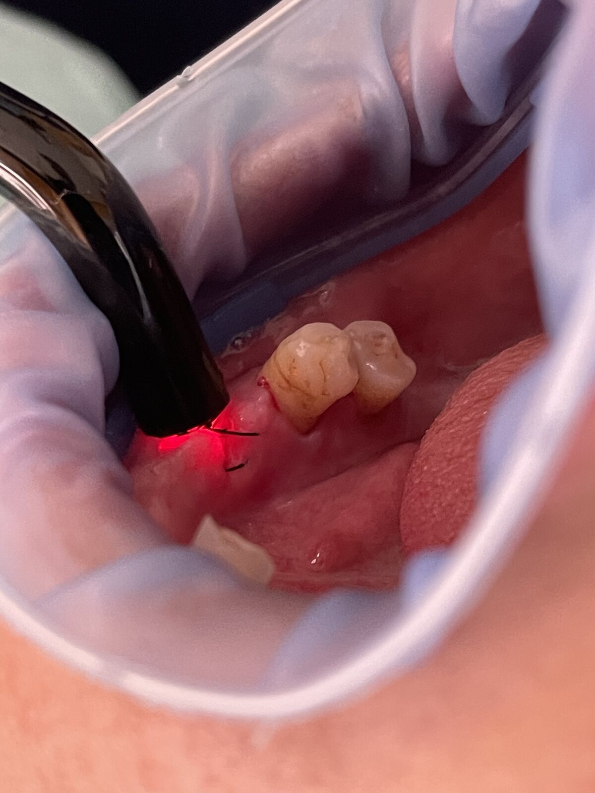 Tratamiento con láser dental: la punta del láser actuando sobre la encía